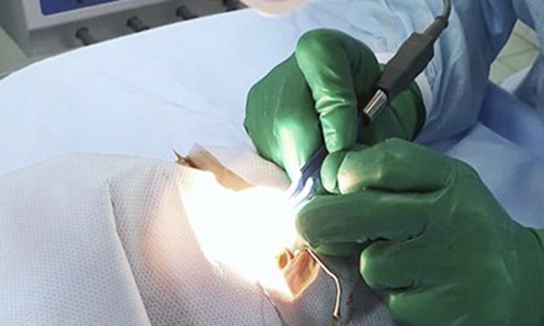 Апробация аппарата RadioSURG ® 2200, Германия